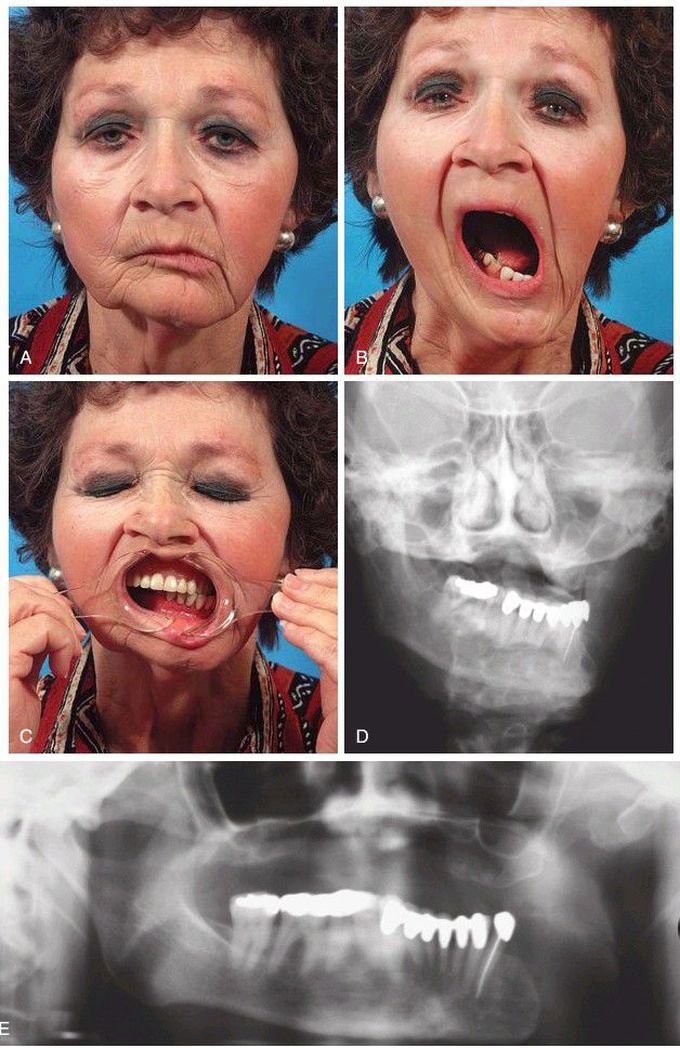 Mandibular deviation following Hemimandibulectomy