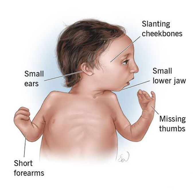 These are the symptoms of Nager syndrome