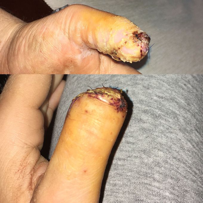 Nail phalangure amputation