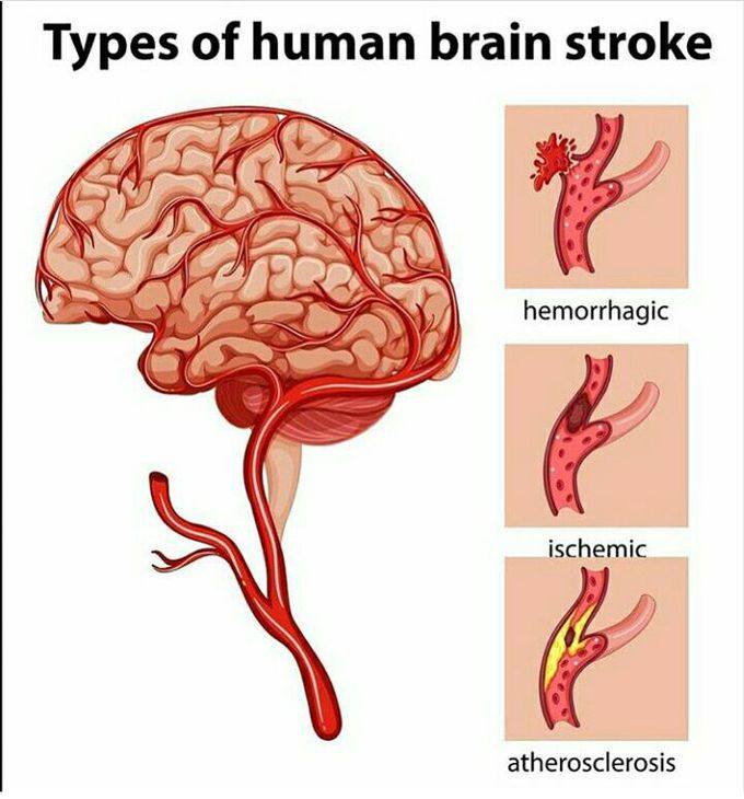 Types of Human brain stroke