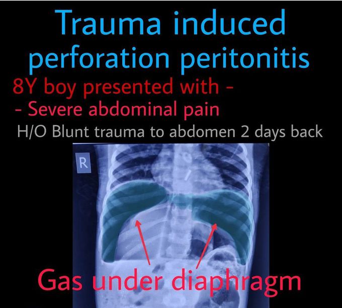 Gas under Diaphragm