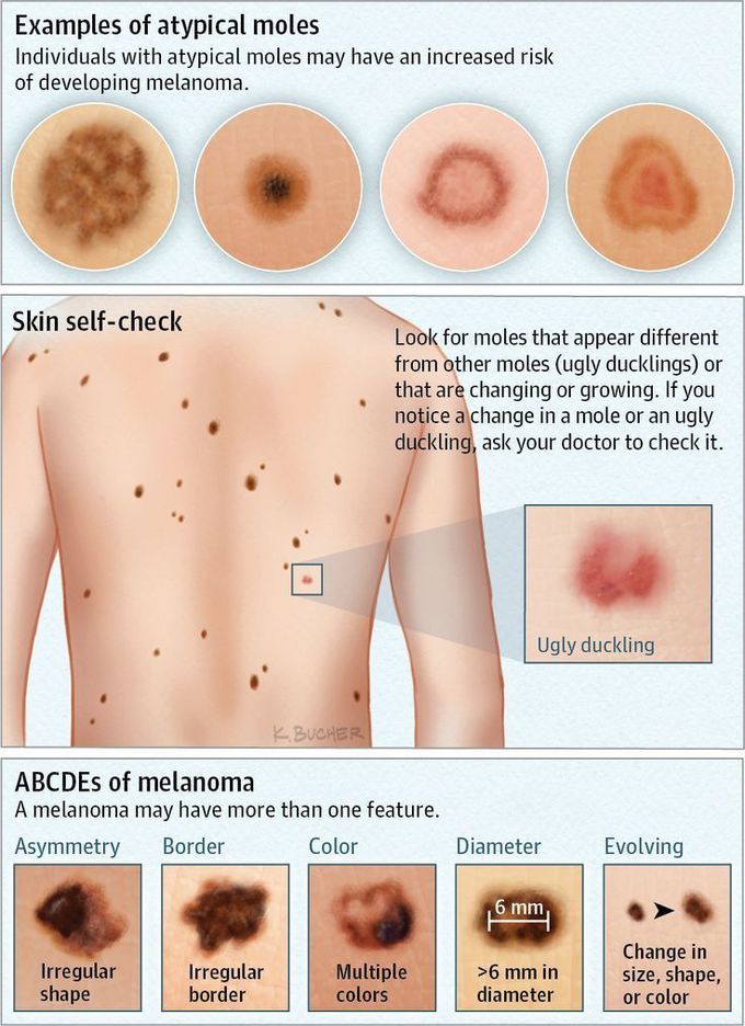 Atypical moles