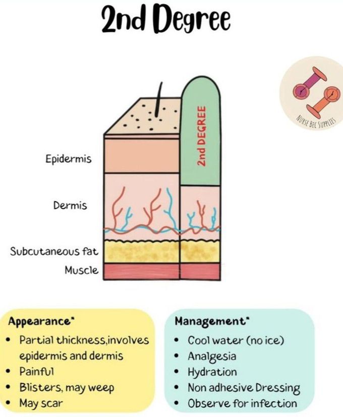 2nd Degree Burn