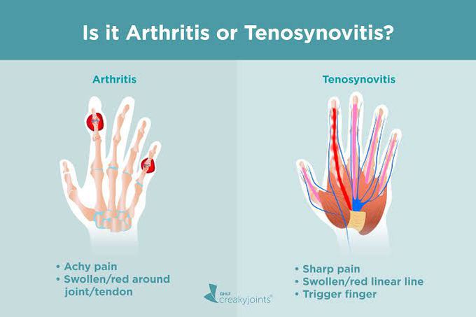 Arthritis Vs Tenosynovitis