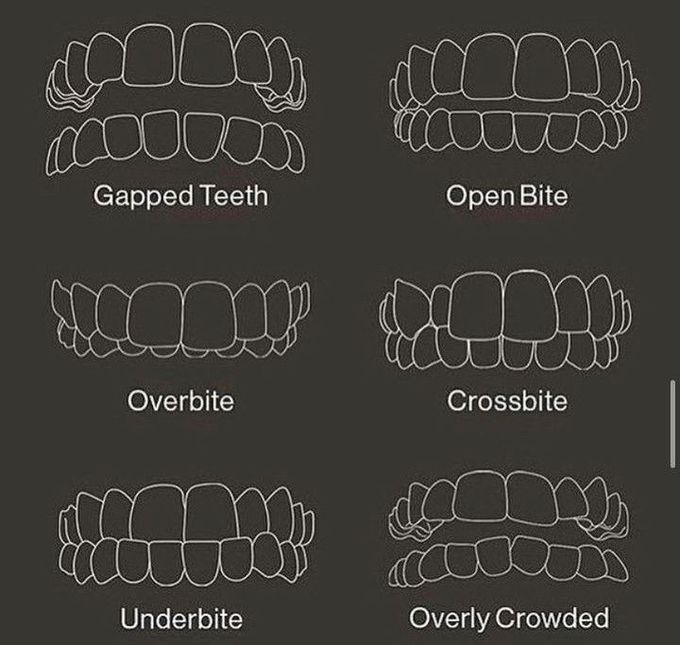 Different Types of Bite