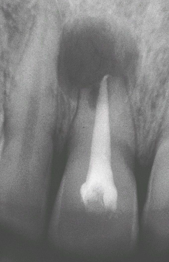 Periapical Cyst