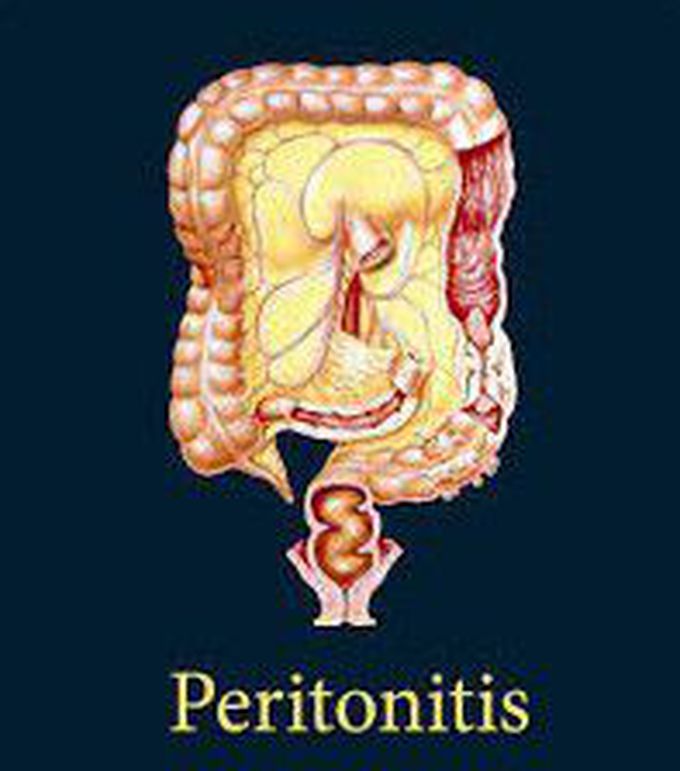 Peritonitis