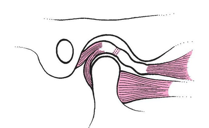 Fibrotic adaptation in anterior disc displacement