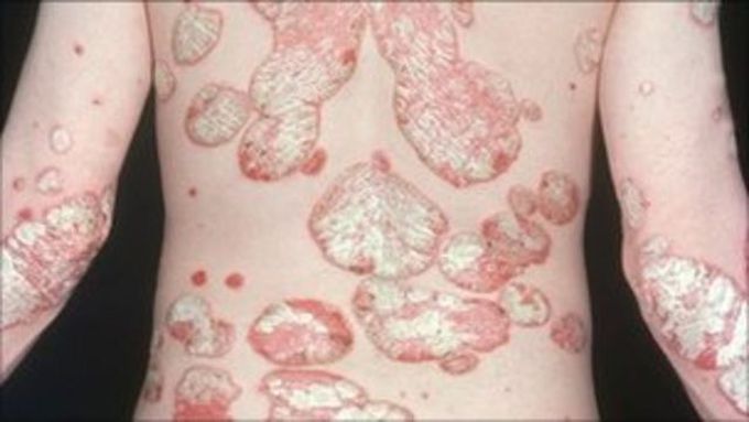 Psoriasis is a common and stigmatising chronic inflammatory skin disease.