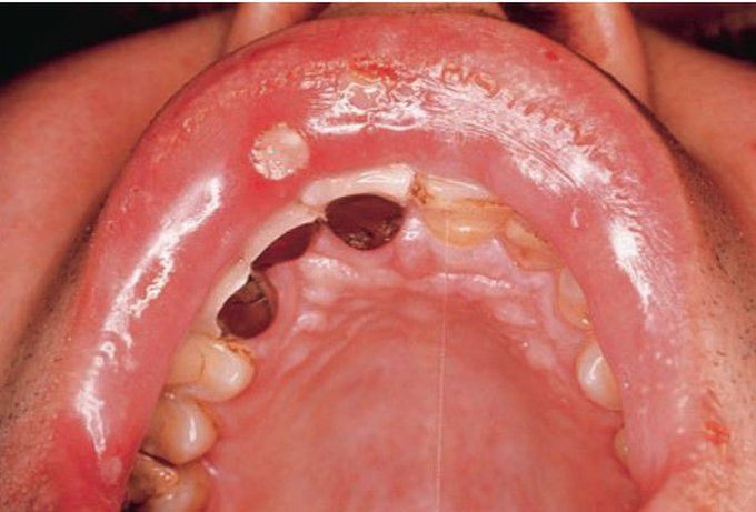 Aphthous ulcers seen in Behcet's disease