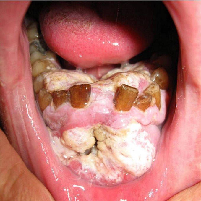 Advanced oral cancer in a 40 year old male smoker!! 