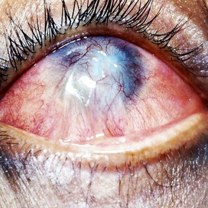 Trauma from battery acid resulting in extensive corneal scarring and vascularization