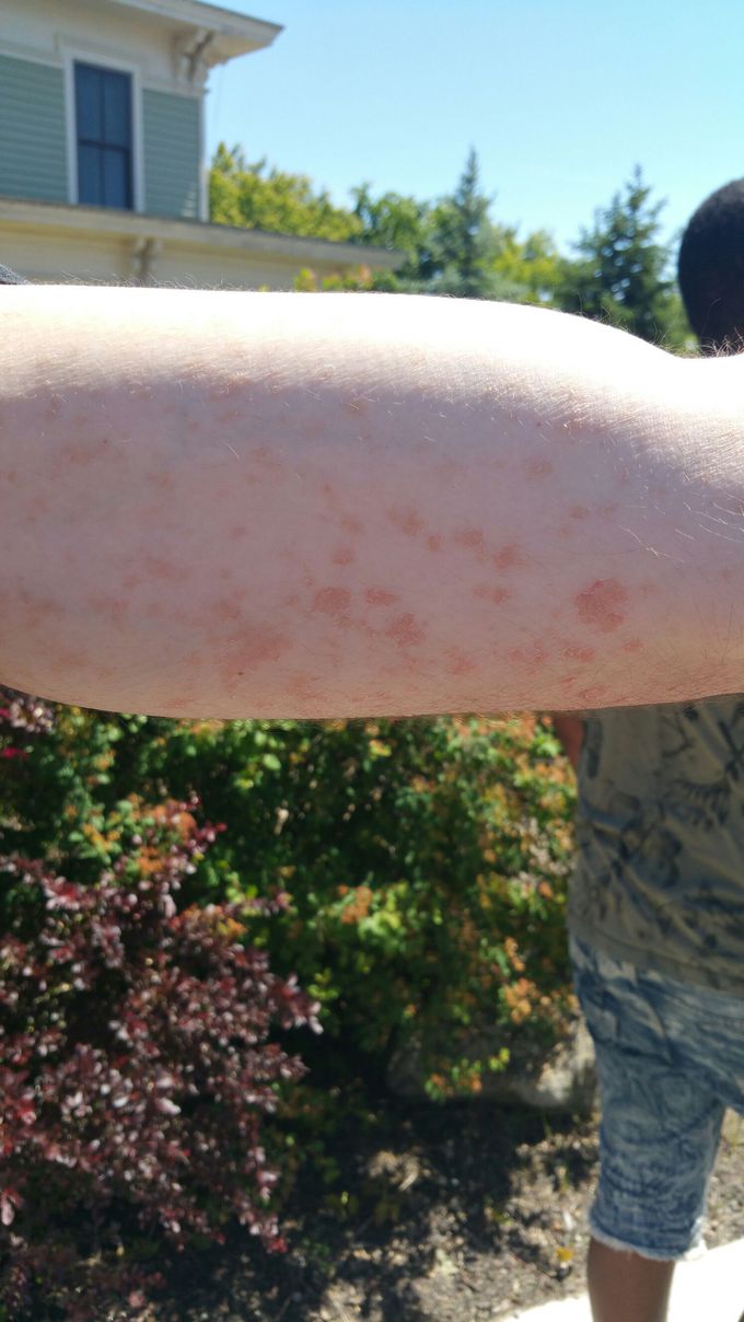 pityriasis rosea