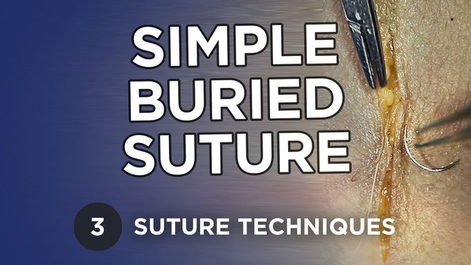 Simple Buried Suture