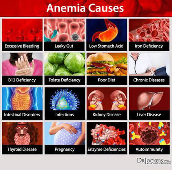 Treatment of anemia is according to the causes