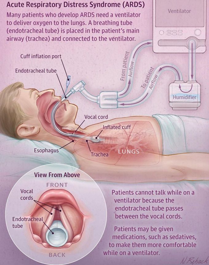 Acute Respiratory Distress Syndrome
