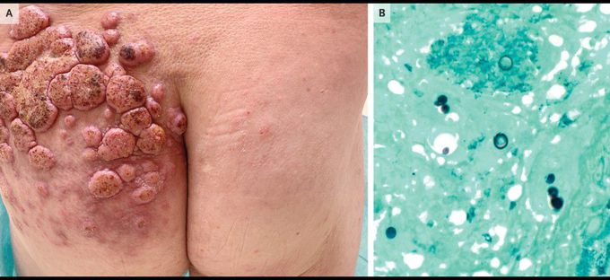 Primary Cutaneous Blastomycosis