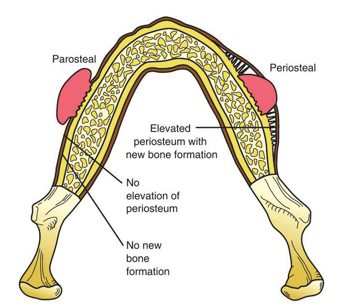 Peripheral (Juxtacortical) Osteosarcoma.