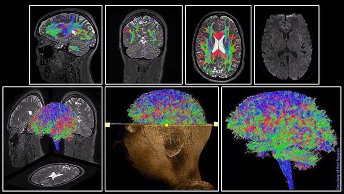 Another figure which presents the power of Simultaneous Multi-Slice (SMS) technique!