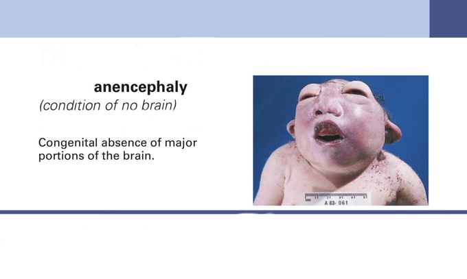 Anencephaly