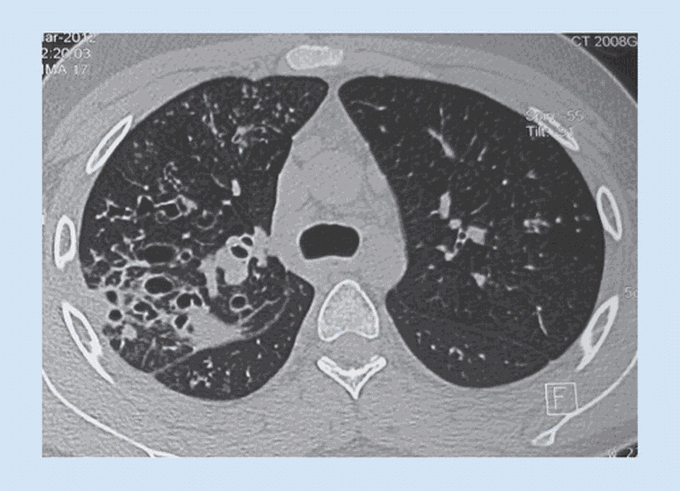 Allergic Bronchopulmonary Aspergillosis