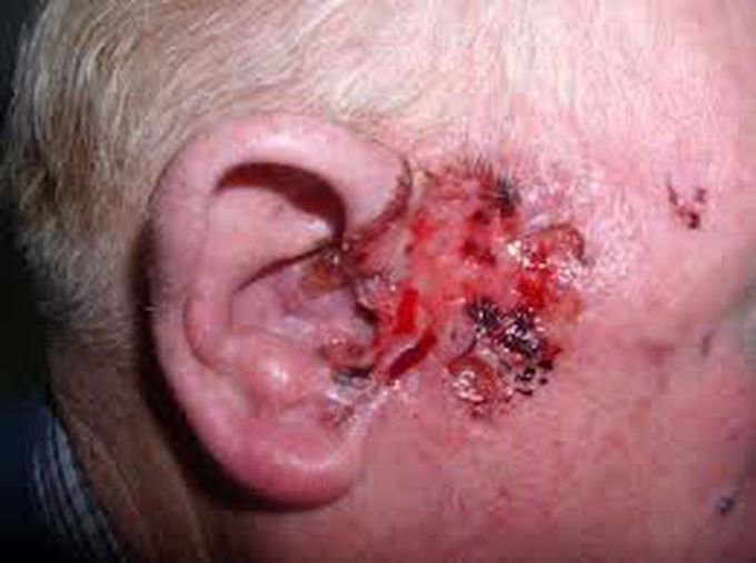 Basal cell carcinoma