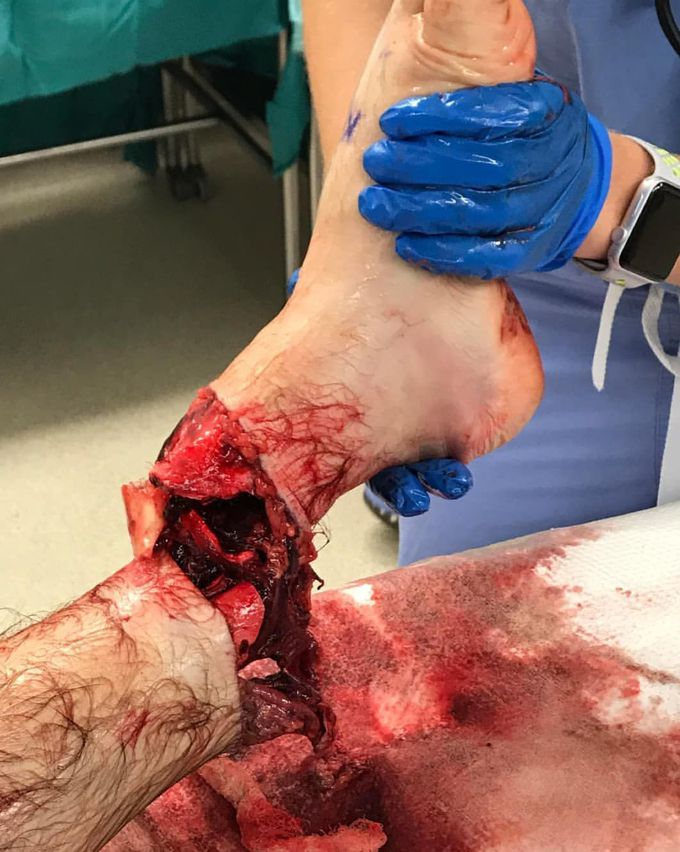 ⚠️ A case of a motorcycle accident!