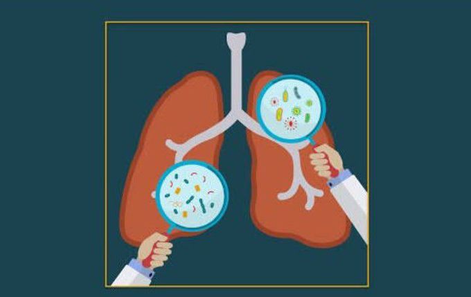 Treatment for Pneumocystis pneumonia.