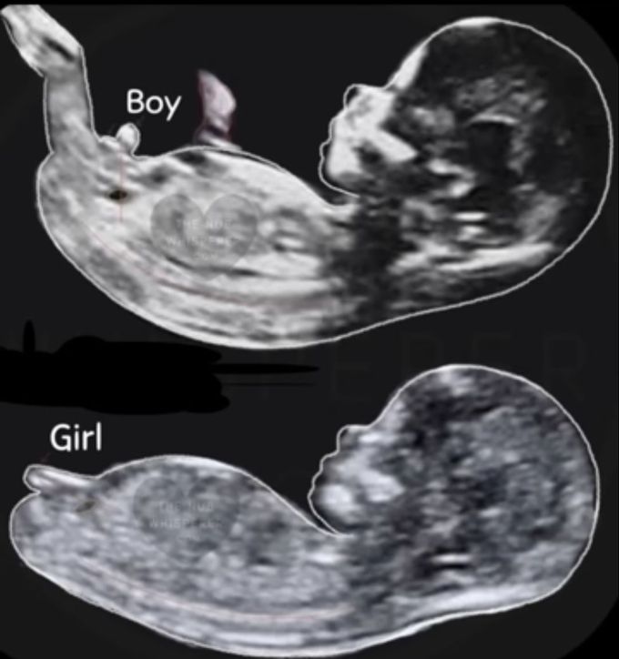 Ultrasound