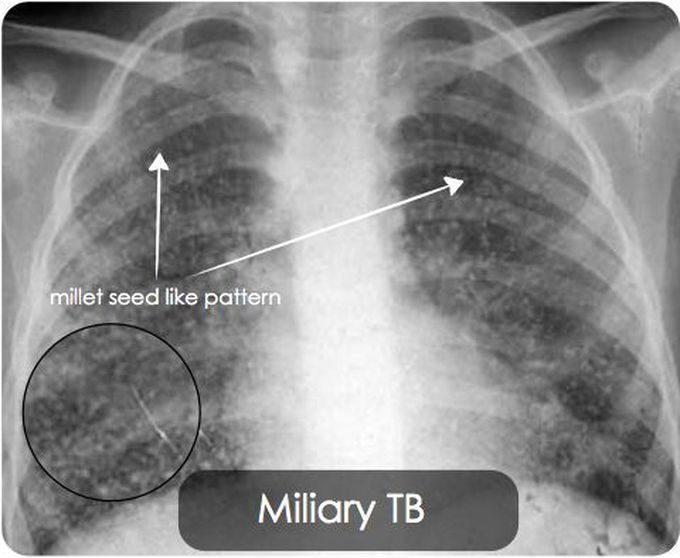 Millet seed appearance on CXR in a patient with Miliary Tuberculosis