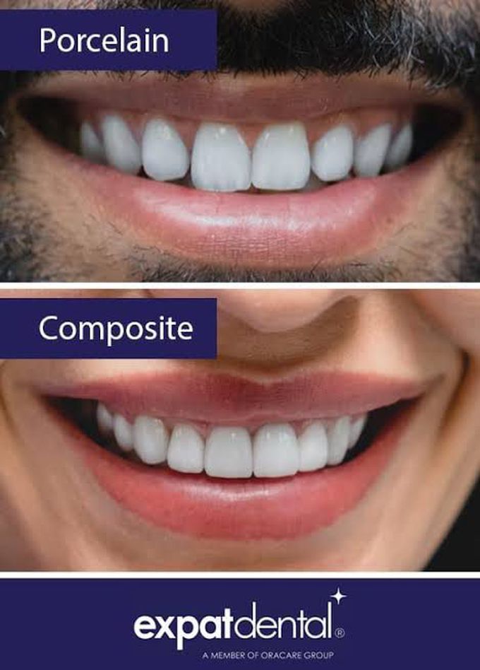 Poreclain vs Composite teeth