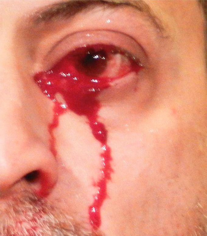 Hemolacria — Crying Blood!!! 