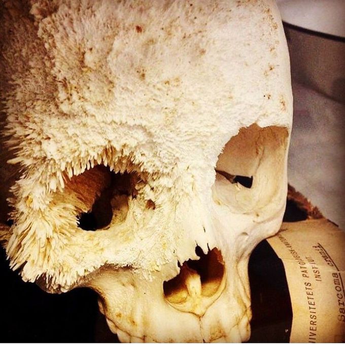 Osteosarcoma