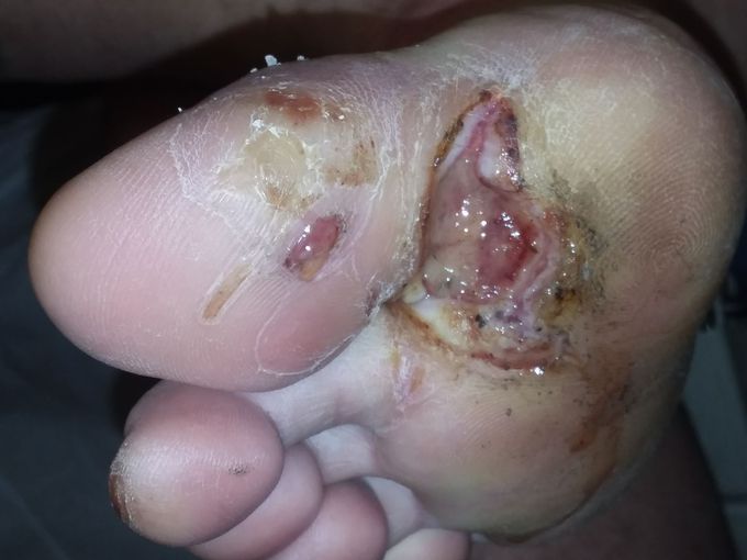 Non healing wound