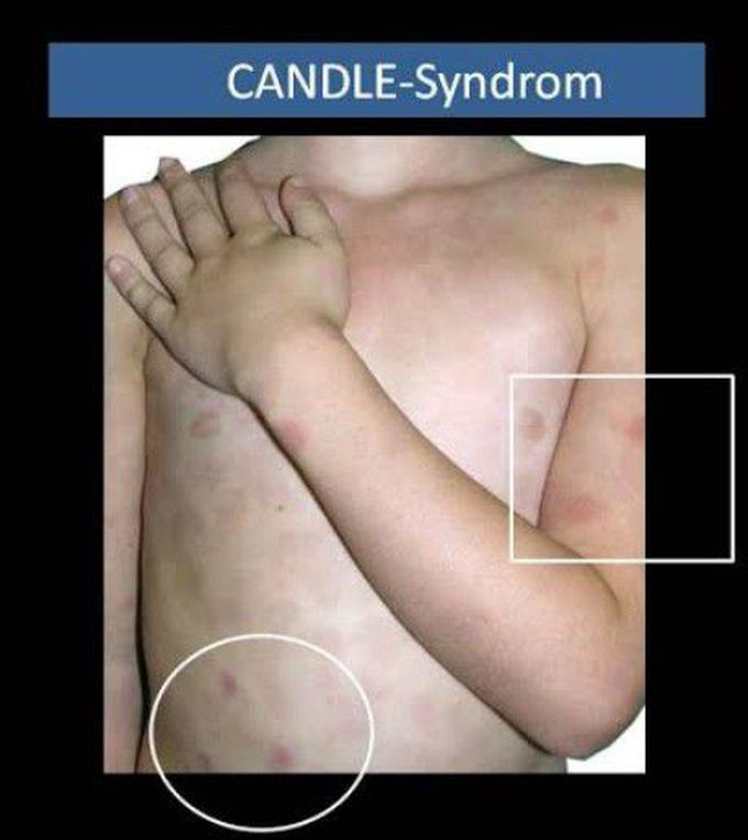 CANDLE syndrome