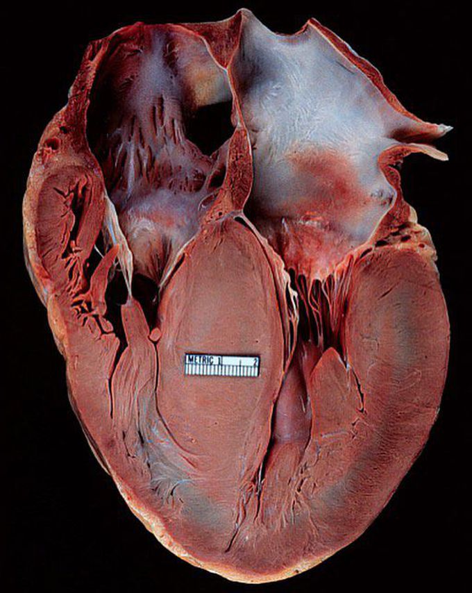 Hypertrophic cardiomyopathy