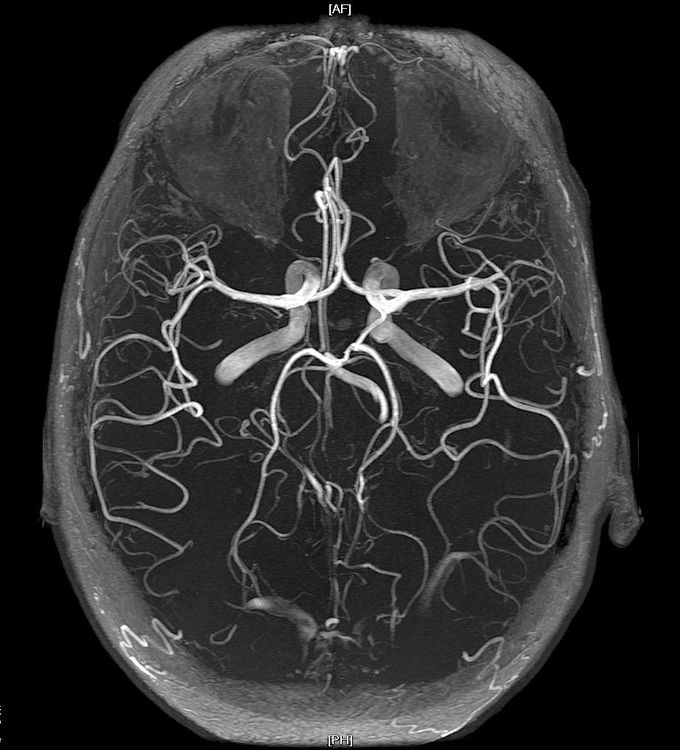 The Circle of Willis