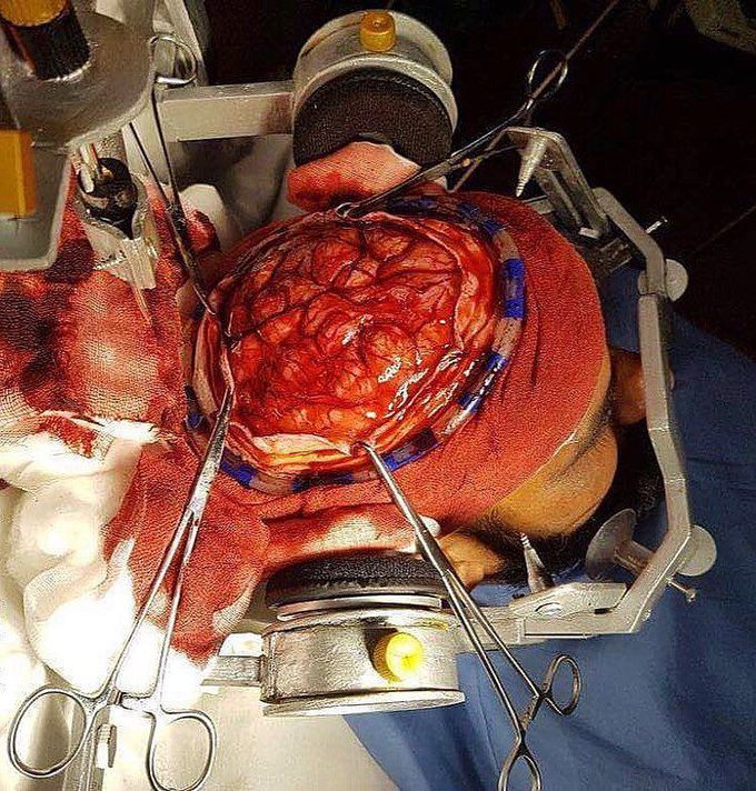 real brain surgery pictures