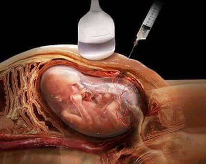 Procedure name ? 👶