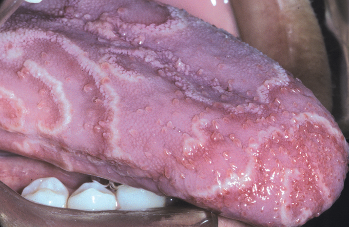 ERYTHEMA MIGRANS (Geographic Tongue)