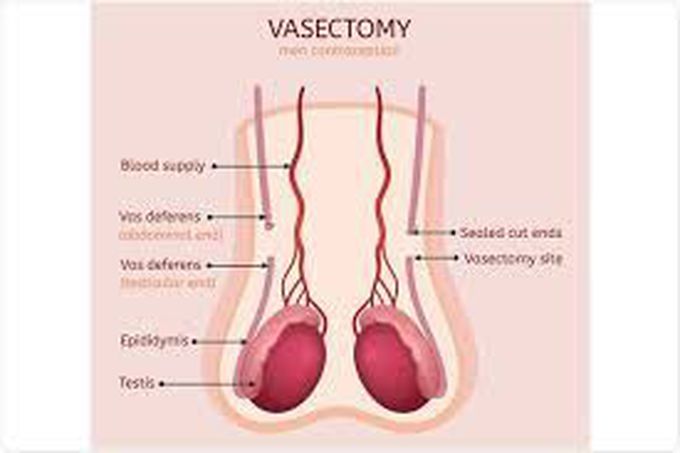 Vasectomy