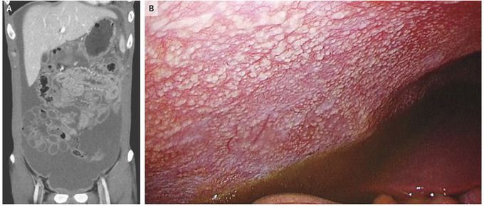 Tuberculous Peritonitis