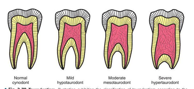 Taurodontism types