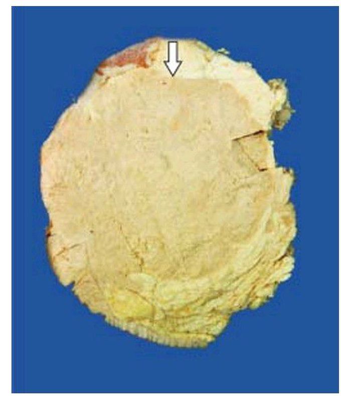 Medullary carcinoma breast.