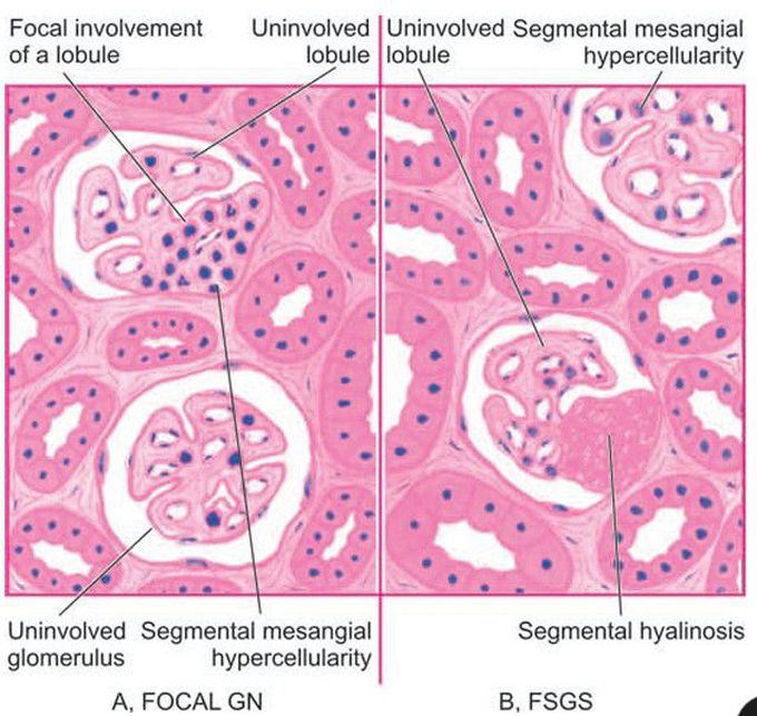 Focal Glomerulonephritis