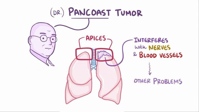 Pancoast tumor