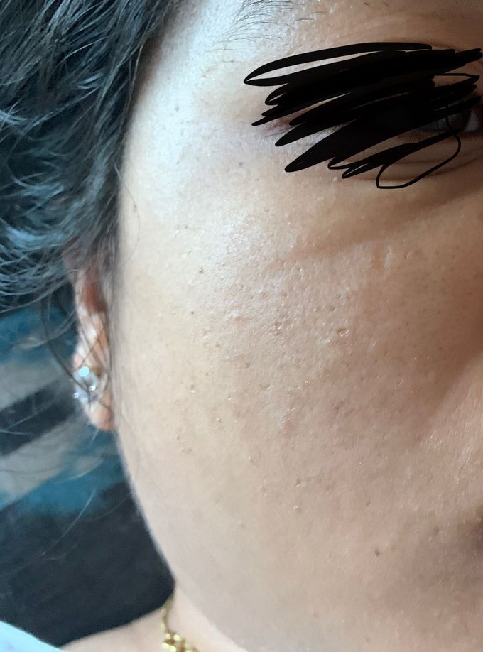 21 years old female patient with complaints of small pores and spots on forehead and cheeks and uneven skin tone
She Was taking treatment for dermatitis but no change in skin 
No extreme sun exposure 
No other complaints