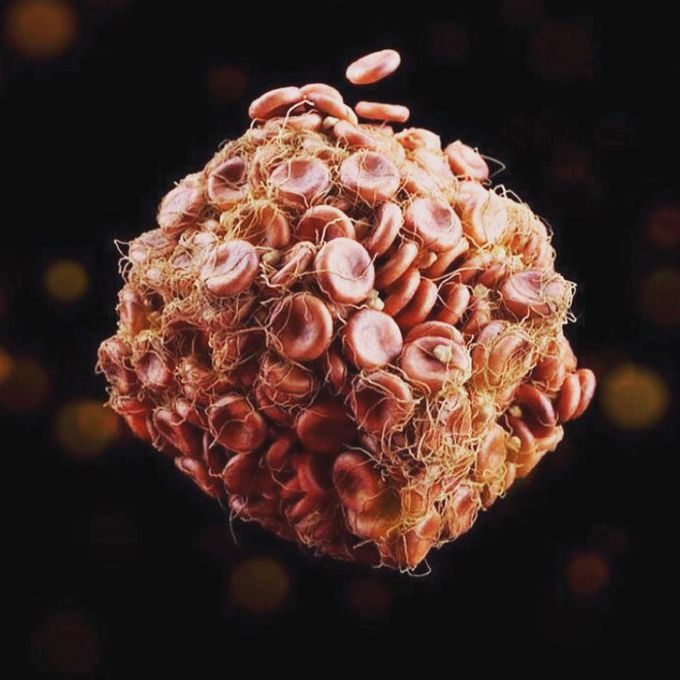 This is a real image of a blood clot!