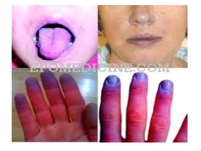 CYANOSIS -- Physical examination