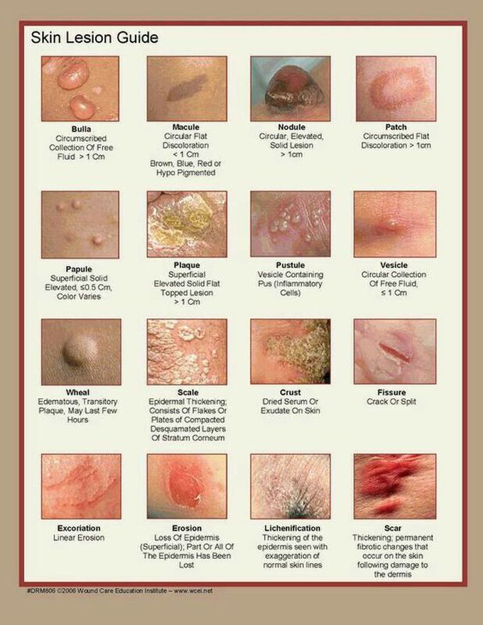 Skin lession
